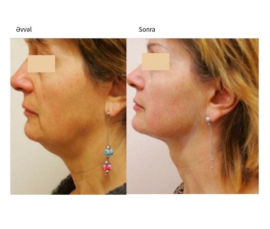 Classys Ultraformer III